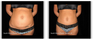 houston tummy tuck before and after