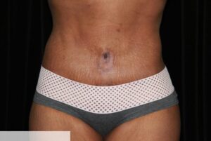 Abdominoplasty Flankplasty Post