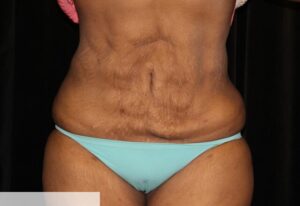 Abdominoplasty Flankplasty Pre