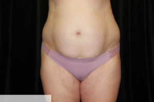 Abdominoplasty with Lipo of Flanks