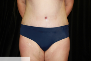 Abdominoplasty with Lipo of Flanks Post