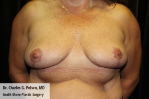 Breast Explant Houston Post 1