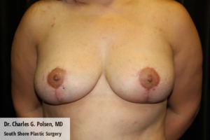 Breast Explant Houston Post 2