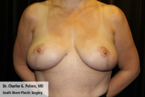 Breast Explant Houston Post