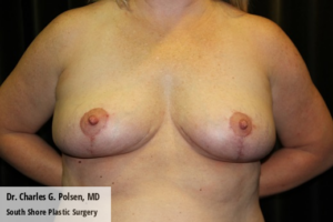 Breast Explant Houston Post 4