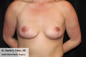 Breast Explant Houston Post 5