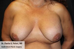 Breast Explant Houston Pre 1