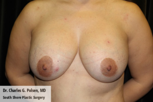 Breast Explant Houston Pre 2