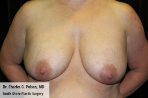 Breast Explant Houston Pre 4