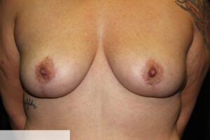 Breast Reduction Clear Lake Post 2