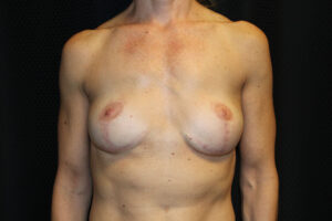 Clear Lake Breast Lift Post