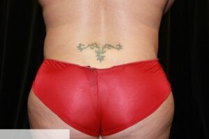 Flankplasty with Lipo of Abdomen Clear Lake Post