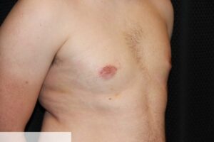 Gynecomastia Clear Lake Post 10