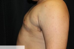 Gynecomastia Clear Lake Post 11