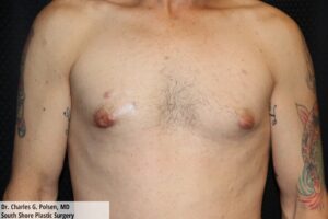 Gynecomastia Clear Lake Post 2