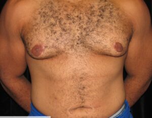 Gynecomastia Clear Lake Post 4