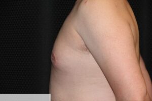 Gynecomastia Clear Lake Post 6