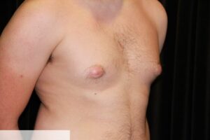 Gynecomastia Clear Lake Pre 10