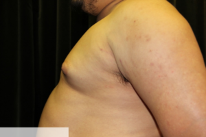 Gynecomastia Clear Lake Pre 11