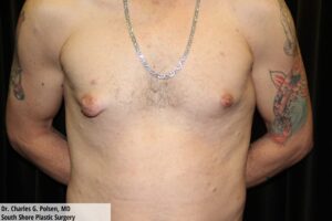 Gynecomastia Clear Lake Pre 2