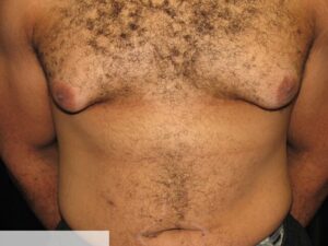 Gynecomastia Clear Lake Pre 4