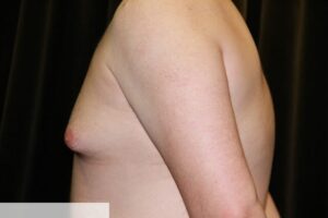 Gynecomastia Clear Lake Pre 6