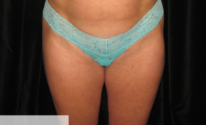 Liposculpting Clear Lake Post 1