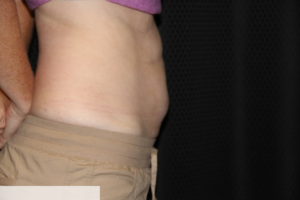 Liposculpting Clear Lake Pre