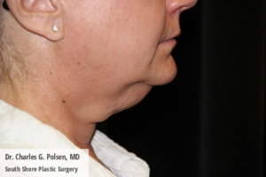 Neck Lift Clear Lake Pre 4