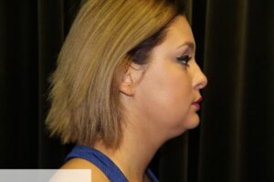 Necklift with Liposuction Pre