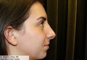 Rhinoplasty Clear Lake Post 1