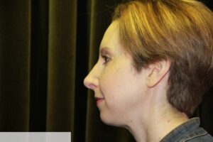 Rhinoplasty Clear Lake Post 3