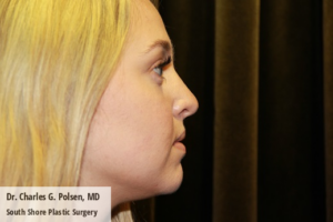 Rhinoplasty Clear Lake Post