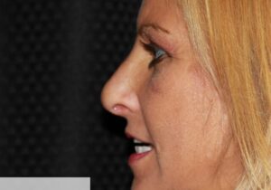 Rhinoplasty Clear Lake Post 7