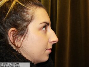 Rhinoplasty Clear Lake Pre 1