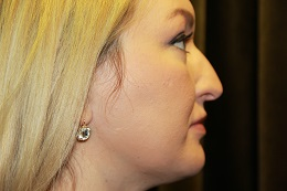 Rhinoplasty Clear Lake Pre 2