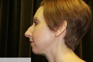 Rhinoplasty Clear Lake Pre 3