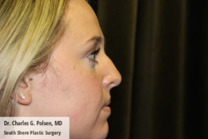 Rhinoplasty Clear Lake Pre