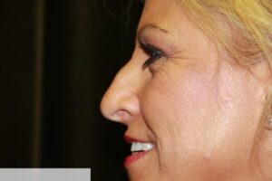 Rhinoplasty Clear Lake Pre 7