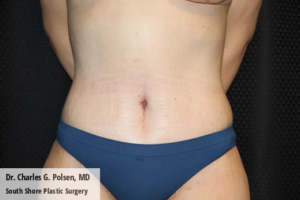 Tummy Tuck Clear Lake Post 11