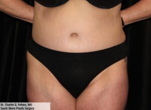 Tummy Tuck Clear Lake Post 13