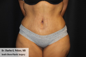 Tummy Tuck Clear Lake Post 14