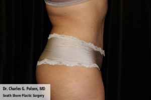 Tummy Tuck Clear Lake Post 8