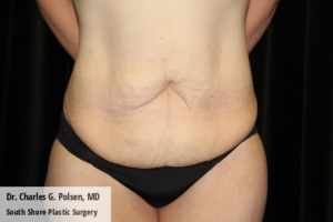 Tummy Tuck Clear Lake Pre 11