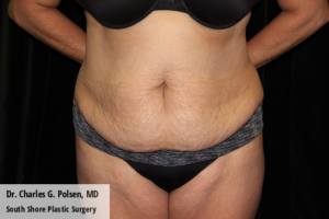 Tummy Tuck Clear Lake Pre 13