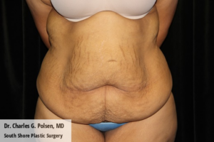 Tummy Tuck Clear Lake Pre 14