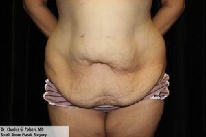 Tummy Tuck Clear Lake Pre 16