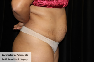 Tummy Tuck Clear Lake Pre 8