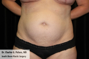 Tummy Tuck Clear Lake Pre 9