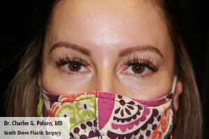 Upper Blepharoplasty Clear Lake Post 6